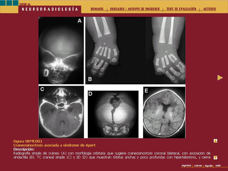 Curso de Neurorradiología - 6