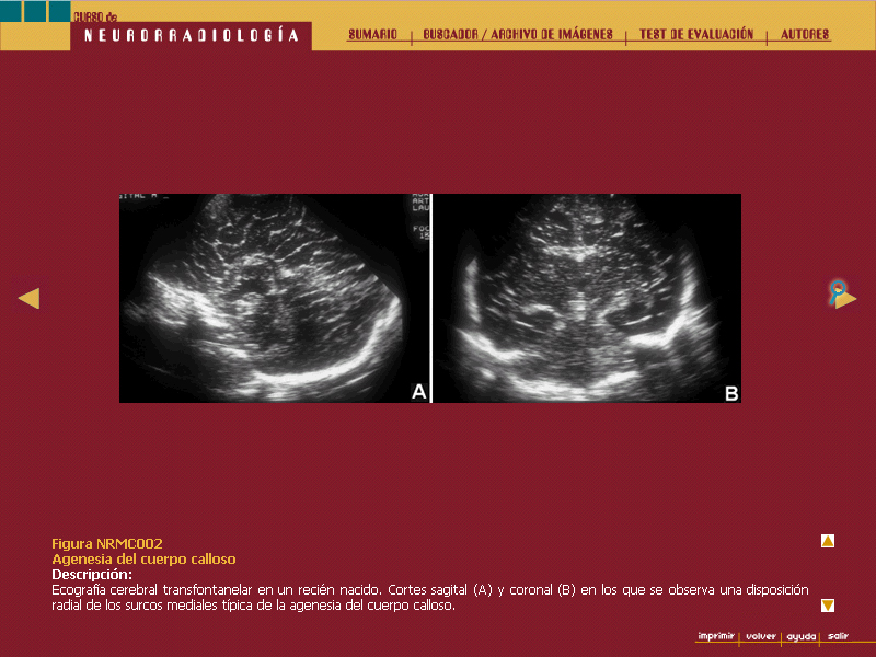 Curso de Neurorradiología - 7