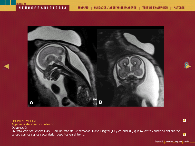 Curso de Neurorradiología - 8