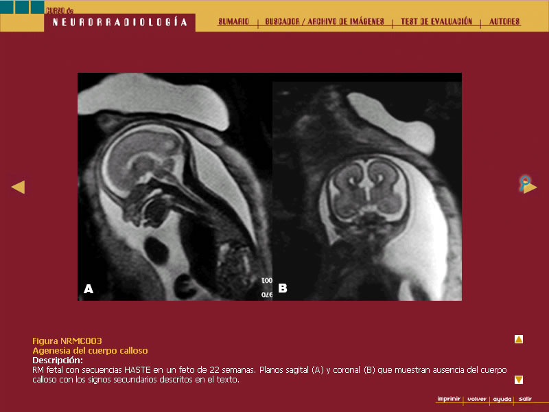Curso de Neurorradiología - 9