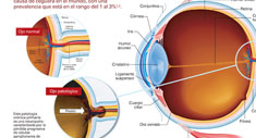 Disco Giratorio Glaucoma