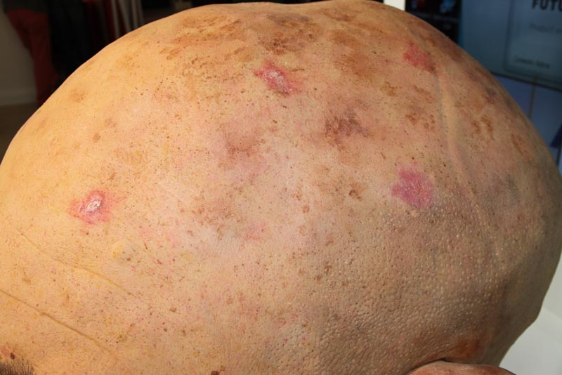 Oversized Derma Trainning Head - 2
