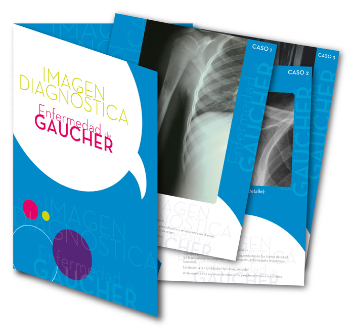 Enfermedad de Gaucher - 2