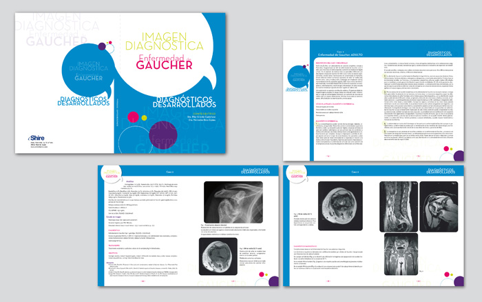Enfermedad de Gaucher - 3