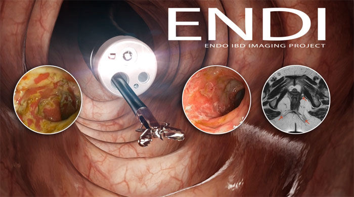 ENDI Endo IBD Imaging Project - 2