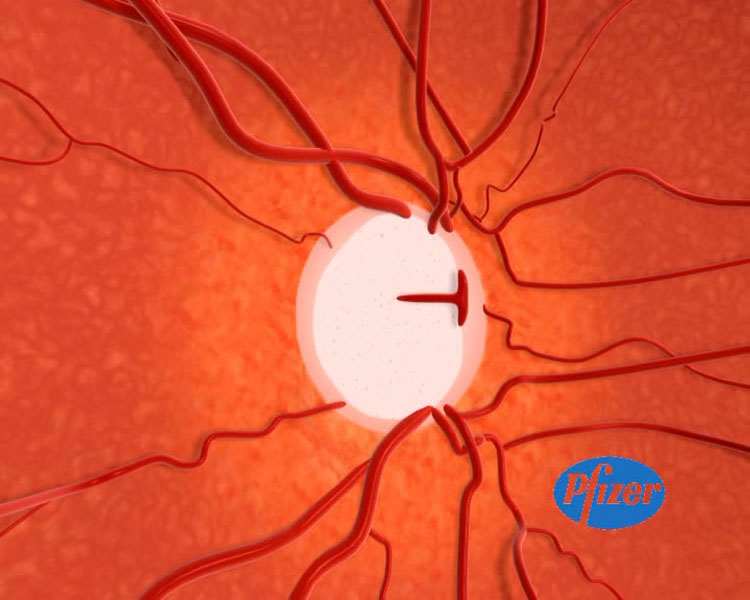 Glaucoma, una enfermedad crónica - 2