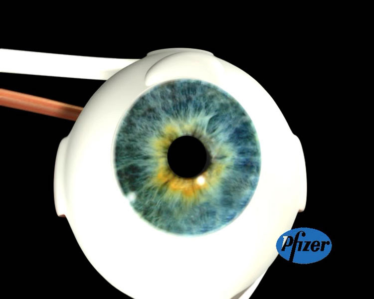 Glaucoma, una enfermedad crónica - 5