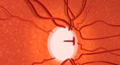 Glaucoma, una enfermedad crónica
