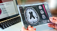 Pérdida de volumen cerebral