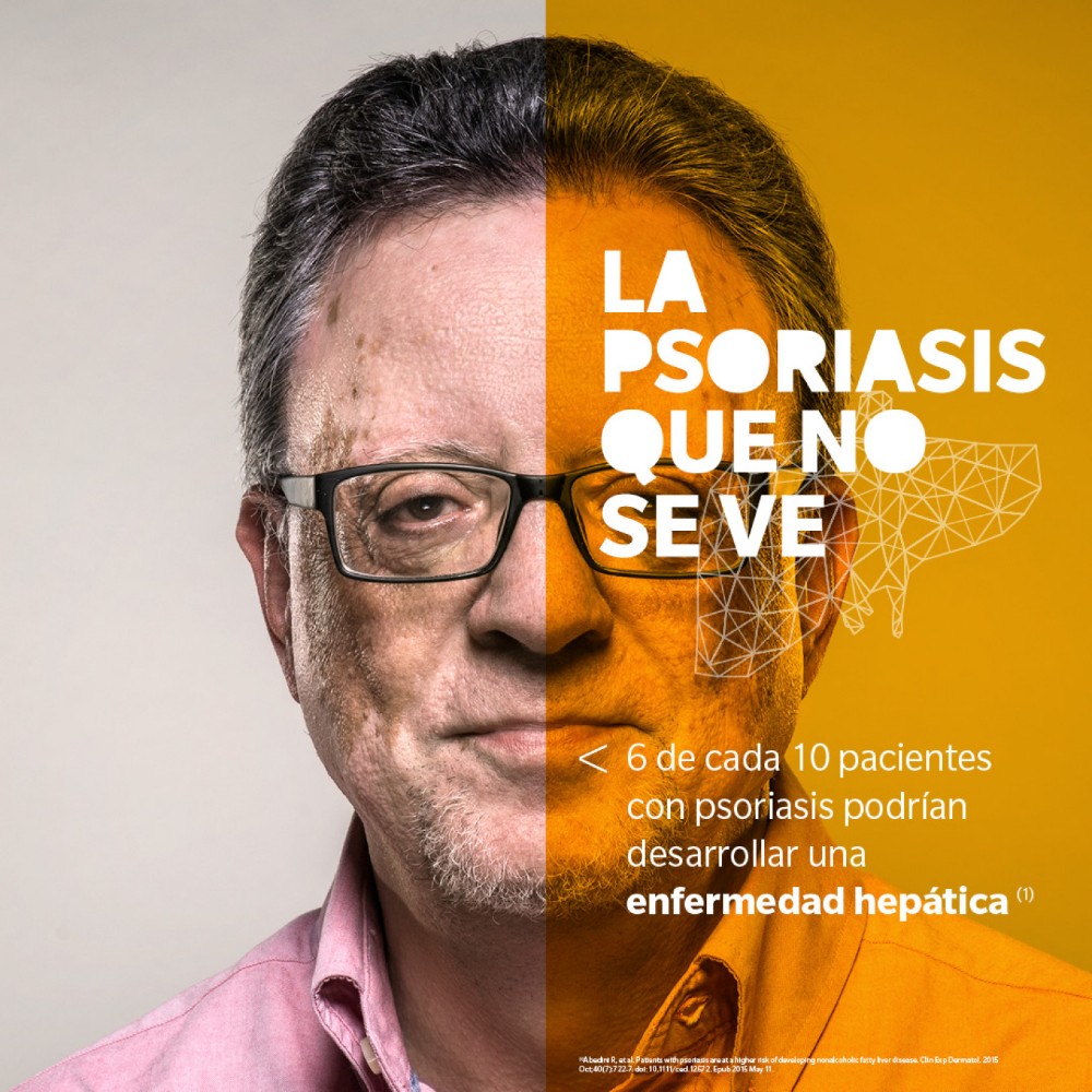 La Psoriasis que No Se Ve - 4