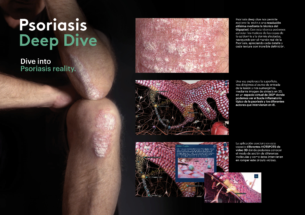 Psoriasis Deep dive - 3