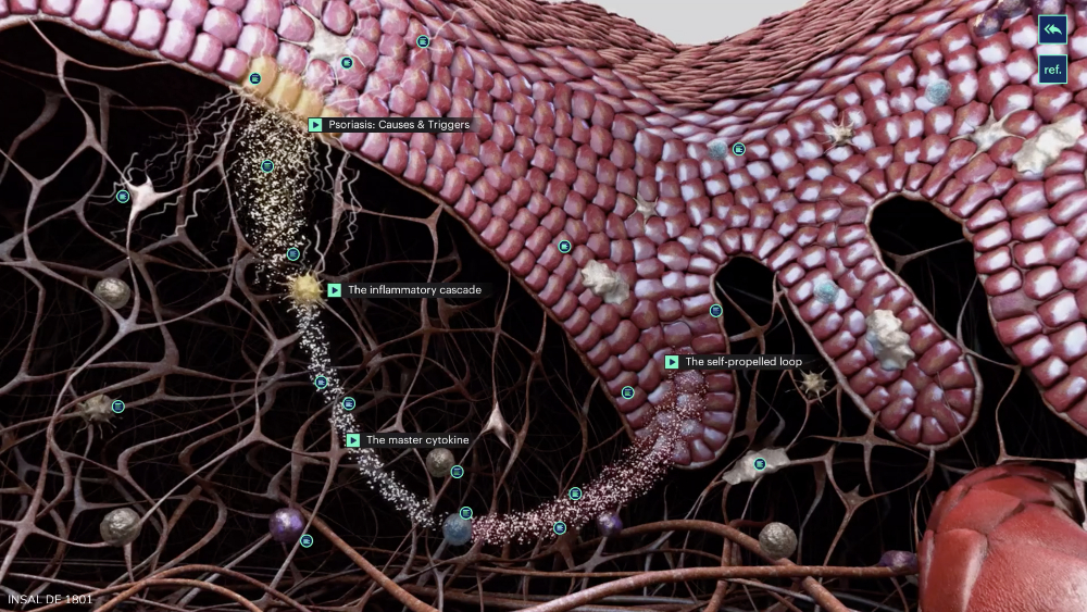 Psoriasis Deep dive - 5