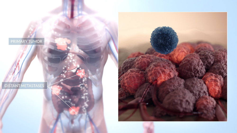 AffyImmune: CART cells video - 4
