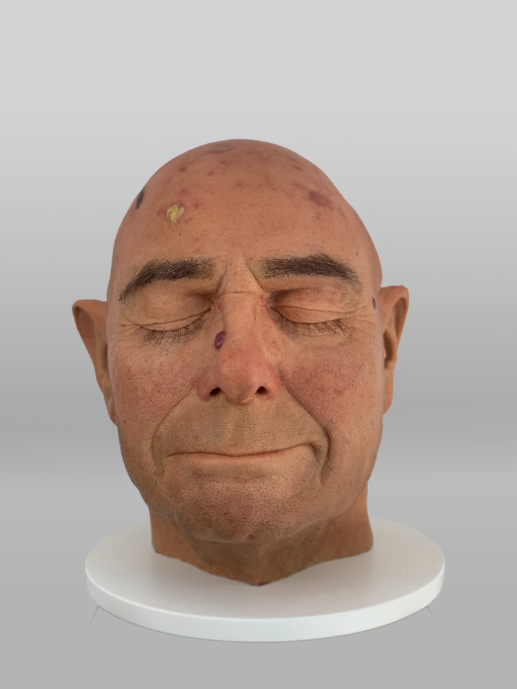 Actinic Keratosis Augmented Reality - 4