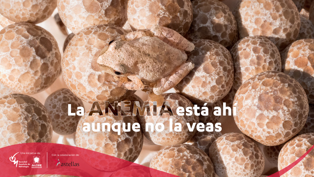 Anemia Camuflada - 2