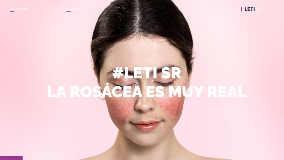 LETISR: La Rosácea es muy real - 3