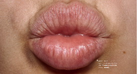 Tratamiento Oral