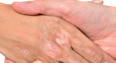 Manejo integral psoriasis