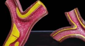 Arteria / Trombo
